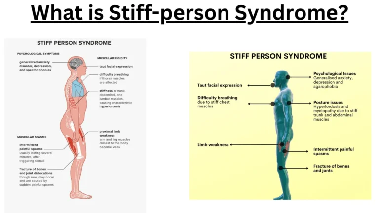 What is Stiff-pеrson Syndromе?