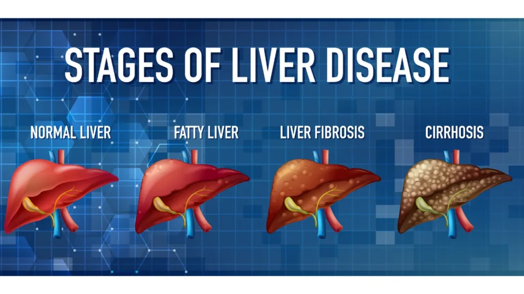 Estrogen's Protective Role Unveiled in Combatting Fatty Liver Disease and Liver Cancer