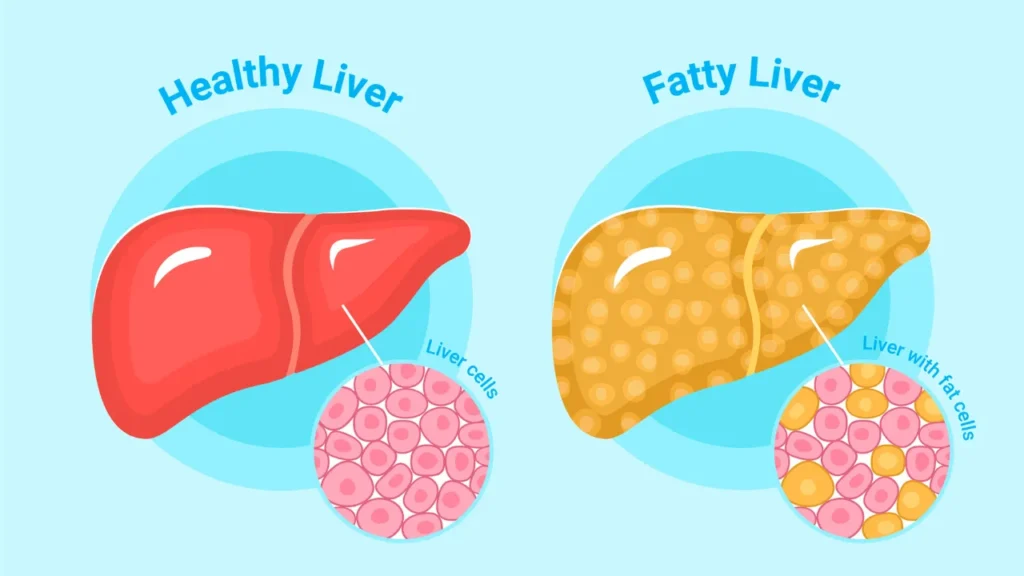 Estrogen's Protective Role Unveiled in Combatting Fatty Liver Disease and Liver Cancer