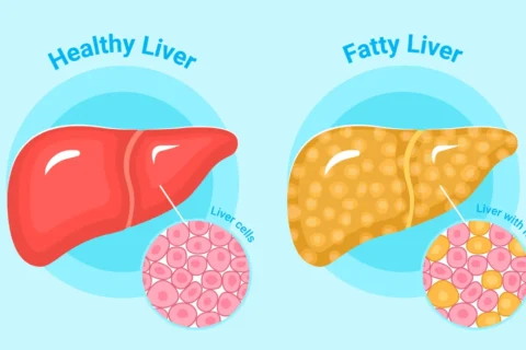 Estrogen's Protective Role Unveiled in Combatting Fatty Liver Disease and Liver Cancer